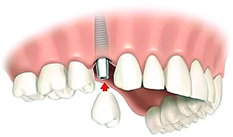 Corona sull impianto dentale