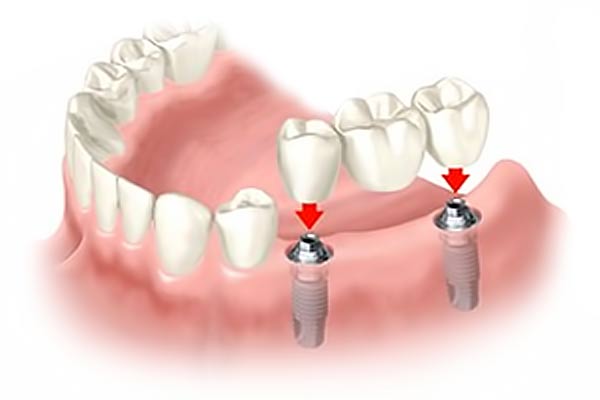 Ponte dentale sugli impianti