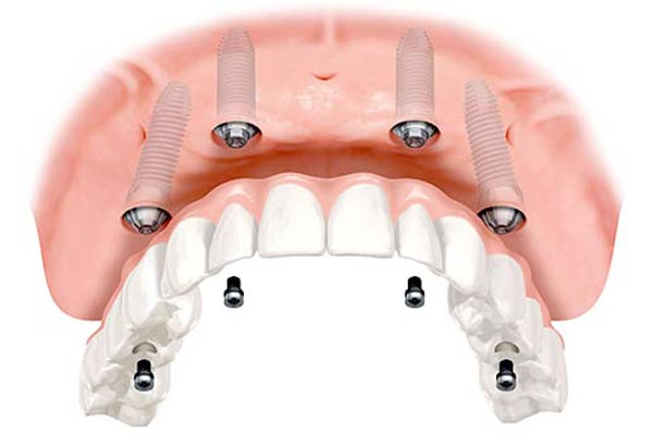 overdenture