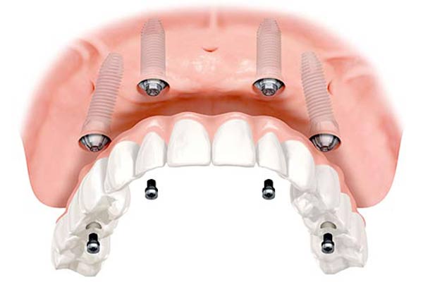 overdenture