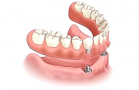 overdenture